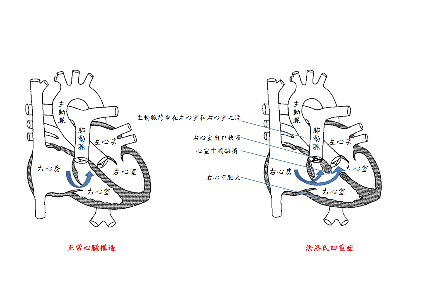 圖一正常心臓及法洛氏四重症結構示意比較，藍色箭頭是表示右心室內血液的流動方向