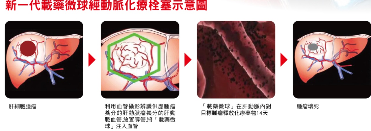 新一代載藥微球經動脈化療栓塞示意圖