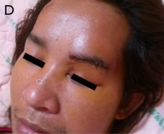 經眉毛開顱術之手術傷口（經左側眉毛）