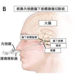 圖二 (B) 經鼻內視鏡腦下垂體腫瘤切除術之示意圖