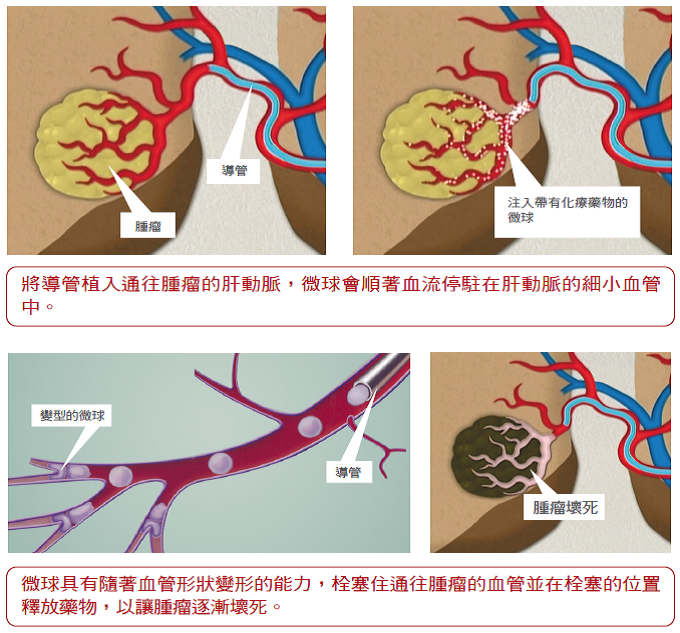 血管栓塞示意圖