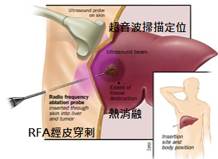 超音波體外引導消融