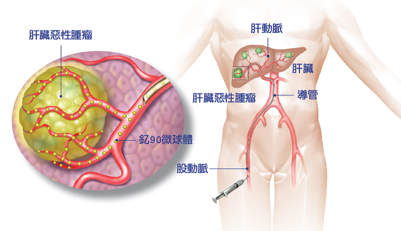 釔90微球體治療示意圖