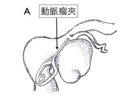 圖五 (A) 開顱夾除（或鉗夾）手術，乃以動脈瘤夾夾除住動脈瘤