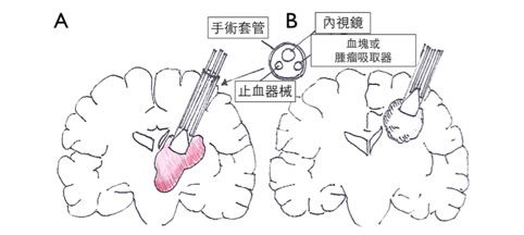 圖四 (A) 內視鏡腦出血清除術 (B) 內視鏡轉移性腦瘤清除術