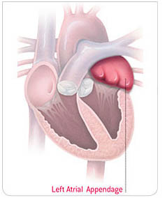 圖一左心耳為一囊狀構造,連接於左心房·(轉載自Boston Scientific網站)