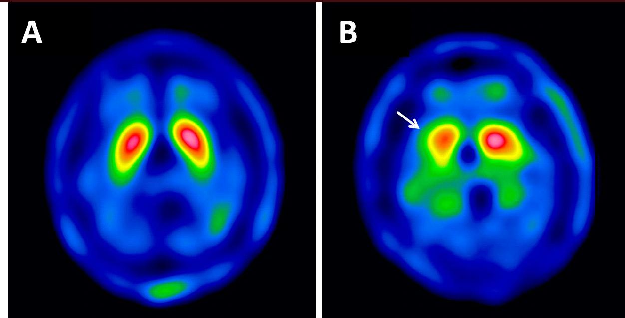 核醫腦部掃描顯示正常與巴金森氏症的多巴胺系統