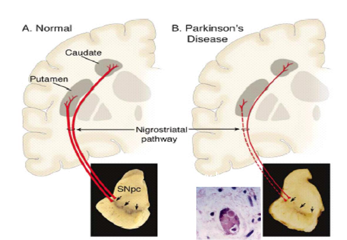 正常與巴金森氏症的腦部病理變化