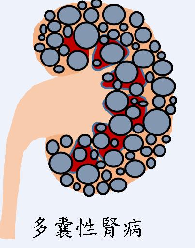 多囊性腎病