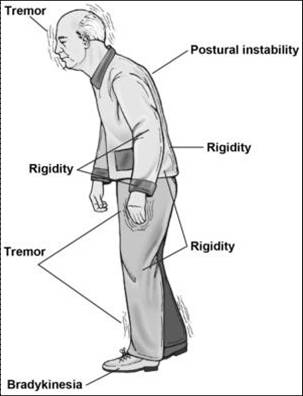 巴金森氏症的臨床症狀