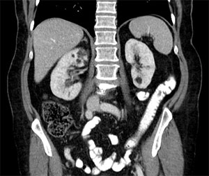結節硬化症病友可能具有之一種腎臟病變之核磁共振影像