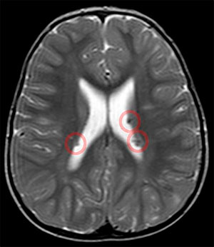 結節硬化症病友可能具有之一種腦內病變之核磁共振影像