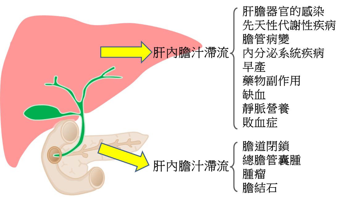 膽汁滯流疾病可能由肝內或肝外，肝細胞或膽道之疾病造成。