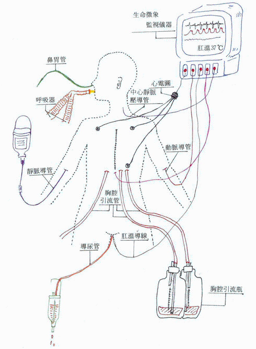 心臟移植術後於加護病房管路示意圖