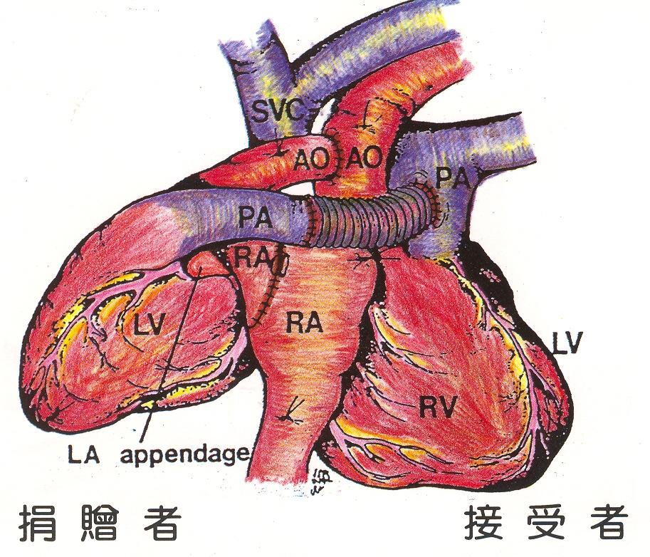 異位心臟移植 異位心臟移植