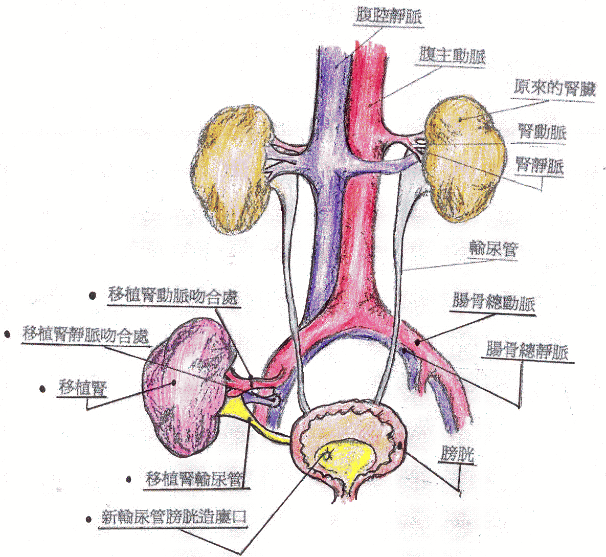 腎臟移植示意圖