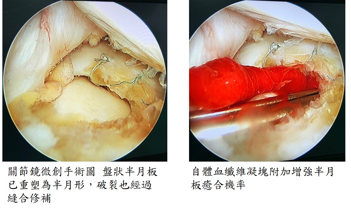 半月板修補_03