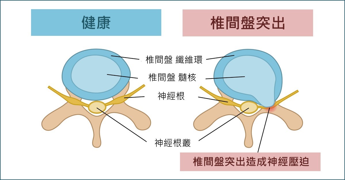 椎間盤突出症