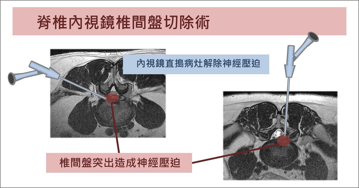 脊椎內視鏡椎間盤切除術