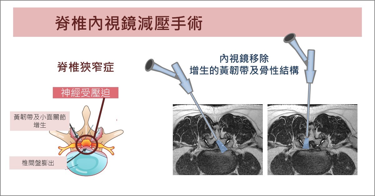 脊椎內視鏡減壓手術