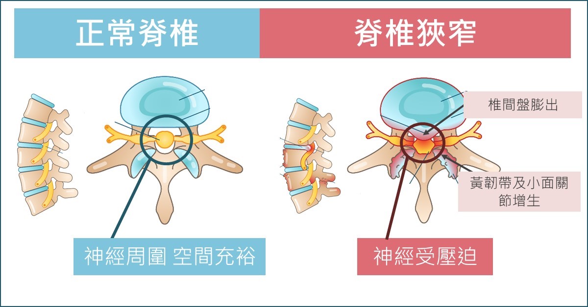 腰椎狹窄症