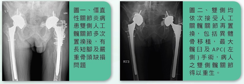 髖關節再置換