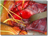 1973年外科完成國內第一例冠狀動脈繞道手術